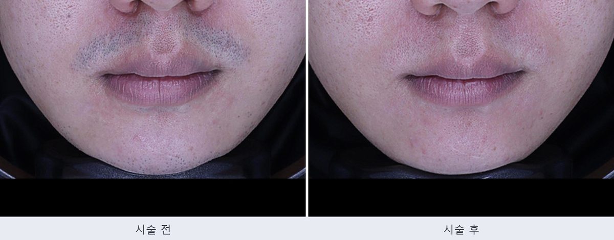 남자 수염 제모