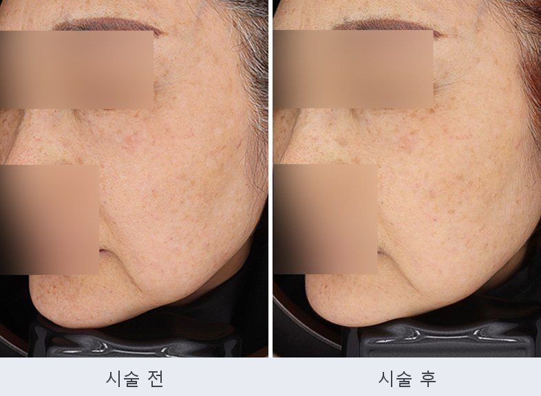 기미 주근깨